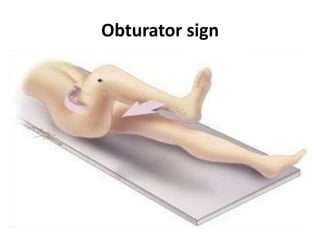 Testing Obturator Sign Acute appendicitis | PPTX