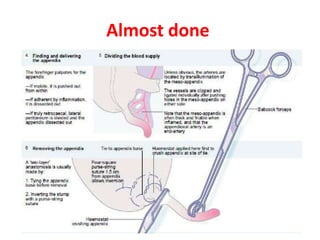 Acute appendicitis | PPTX
