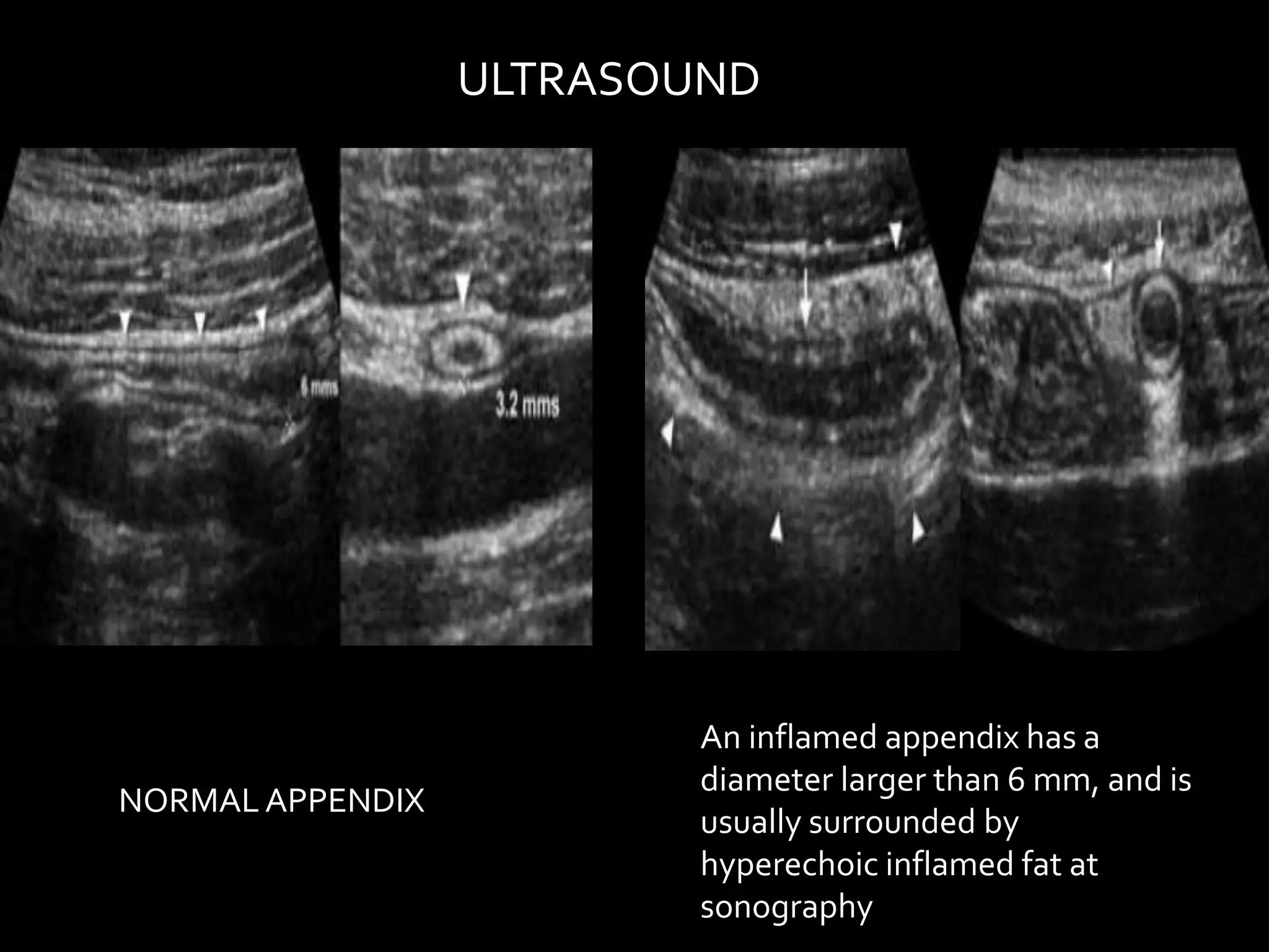 Imaging of Acute Appendicitis | PPT