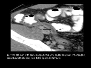 20-year-old man with acute appendicitis.Oral and IV contrast-enhancedCT
scan shows thickened, fluid-filled appendix (arrows).
 