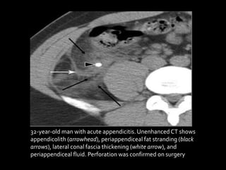 32-year-old man with acute appendicitis.UnenhancedCT shows
appendicolith (arrowhead), periappendiceal fat stranding (black
arrows), lateral conal fascia thickening (white arrow), and
periappendiceal fluid. Perforation was confirmed on surgery
 