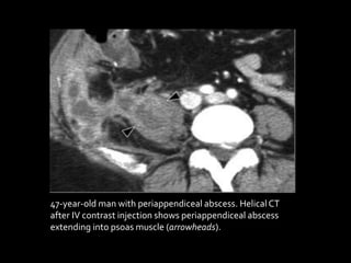 47-year-old man with periappendiceal abscess. Helical CT
after IV contrast injection shows periappendiceal abscess
extending into psoas muscle (arrowheads).
 