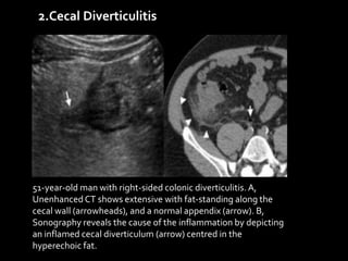 2.Cecal Diverticulitis
51-year-old man with right-sided colonic diverticulitis. A,
UnenhancedCT shows extensive with fat-standing along the
cecal wall (arrowheads), and a normal appendix (arrow). B,
Sonography reveals the cause of the inflammation by depicting
an inflamed cecal diverticulum (arrow) centred in the
hyperechoic fat.
 