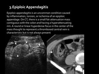 3.Epiploic Appendagitis
Epiploic appendagitis is an uncommon condition caused
by inflammation, torsion, or ischemia of an epiploic
appendage.On CT, there is a small fat-attenuation mass
contiguous with the colon and having a hyperattenuating
rim. A round or linear hyperdense focus in the center of the
mass thought to represent a thrombosed central vein is
characteristic but is not always present
 