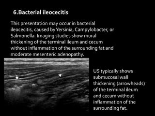 6.Bacterial ileocecitis
This presentation may occur in bacterial
ileocecitis, caused byYersinia, Campylobacter, or
Salmonella. Imaging studies show mural
thickening of the terminal ileum and cecum
without inflammation of the surrounding fat and
moderate mesenteric adenopathy.
US typically shows
submucosal wall
thickening (arrowheads)
of the terminal ileum
and cecum without
inflammation of the
surrounding fat.
 
