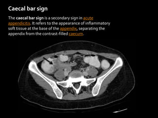 Caecal bar sign
The caecal bar sign is a secondary sign in acute
appendicitis. It refers to the appearance of inflammatory
soft tissue at the base of the appendix, separating the
appendix from the contrast-filled caecum.
 