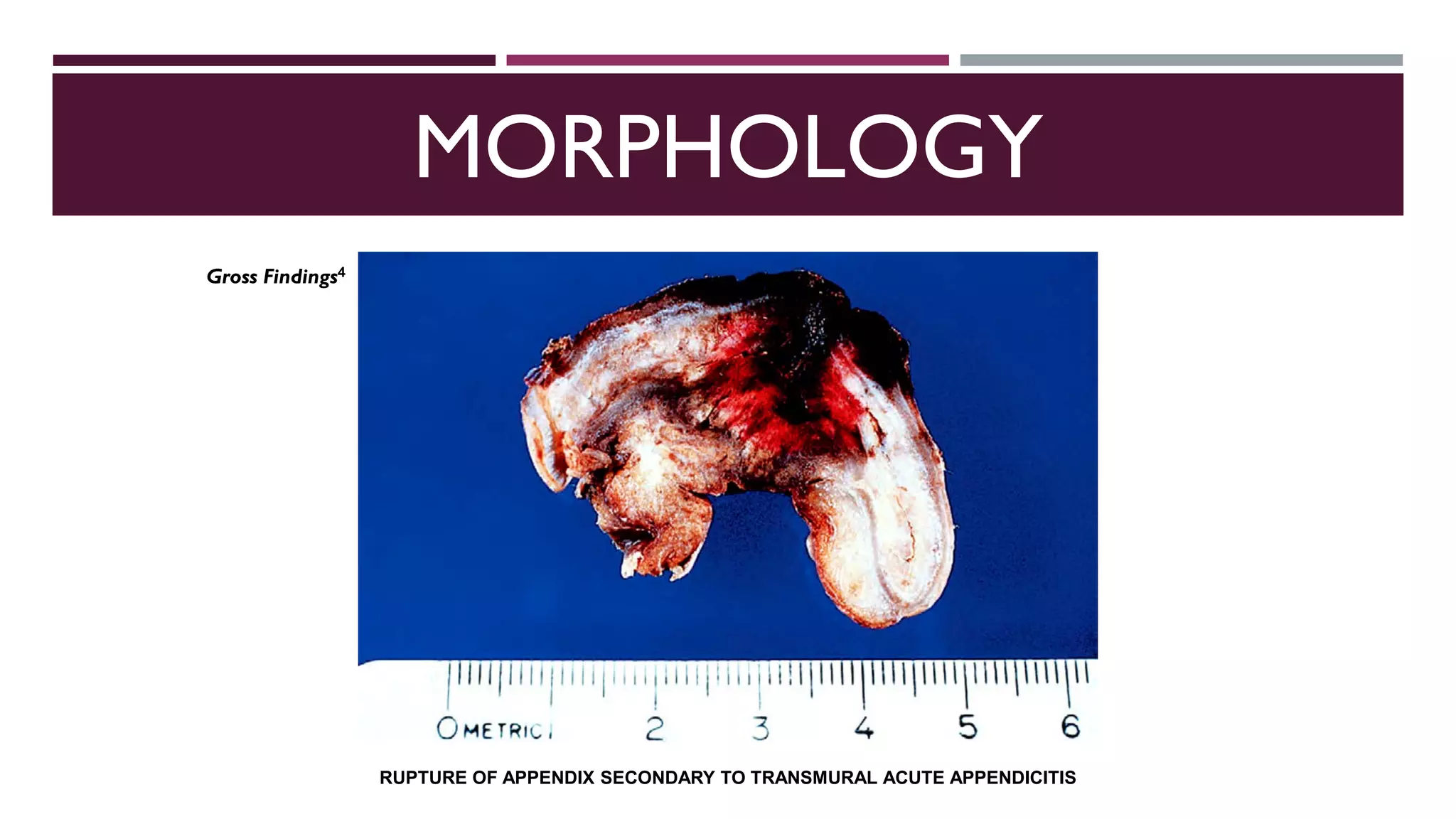 Acute Appendicitis | PDF
