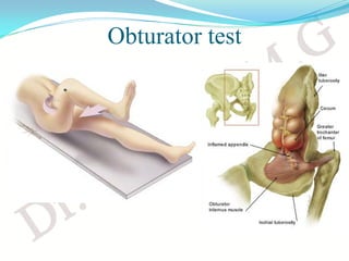 Acute appendicitis | PDF