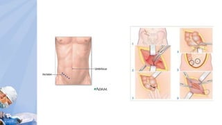 Acute appendicitis -Case Presentation