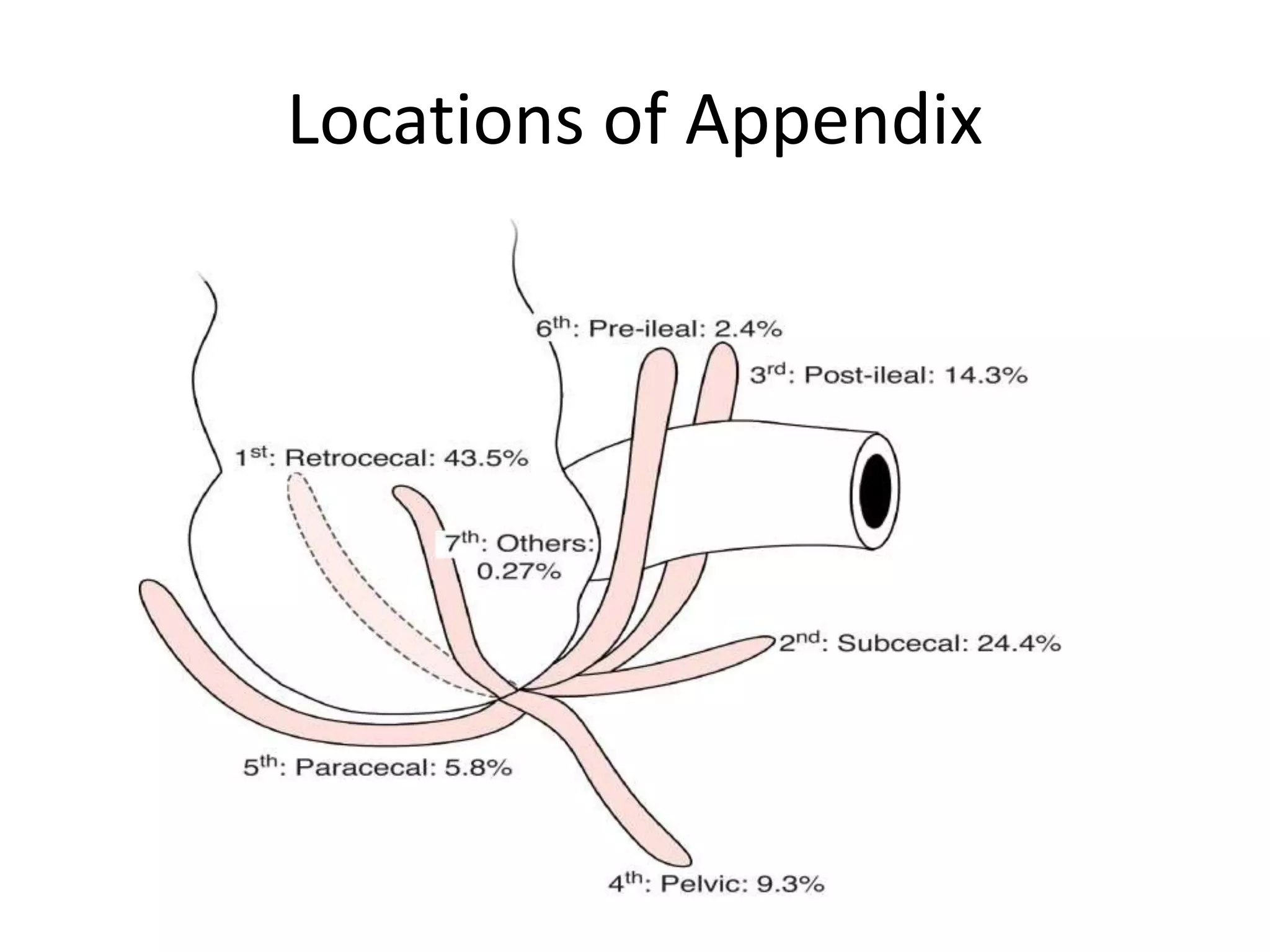 Acute appendicitis | PPT