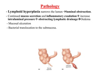 Pathology
- Lymphoid hyperplasia narrows the lumen luminal obstruction.
- Continued mucus secretion and inflammatory exudation increase
intraluminal pressure obstructing lymphatic drainageOedema
- Mucosal ulceration
- Bacterial translocation to the submucosa.
 