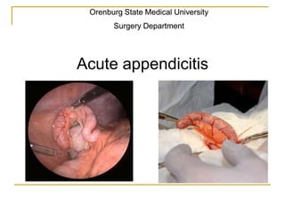 Orenburg State Medical University
Surgery Department
Acute appendicitis
 
