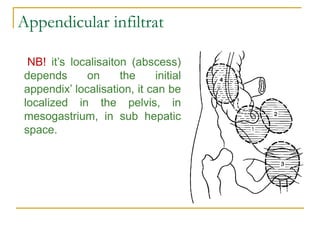 Appendix Inlet Acute appendicitis.pdf