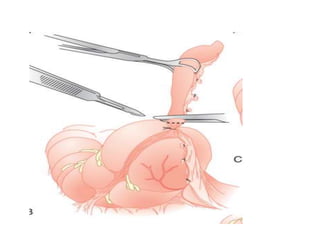 Acute appendicitis.ppt