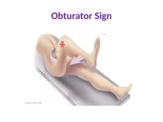 Obturator Sign
 