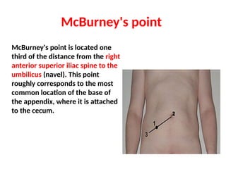 McBurney's point
McBurney's point is located one
third of the distance from the right
anterior superior iliac spine to the
umbilicus (navel). This point
roughly corresponds to the most
common location of the base of
the appendix, where it is attached
to the cecum.
 
