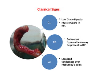 Classical Signs:
01.
• Low Grade Pyrexia
• Muscle Guard in
RIF.
02.
• Cutaneous
hyperesthesia may
be present in RIF.
03.
• Localized
tenderness over
McBurney’s point
 