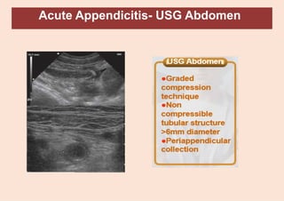 Acute Appendicitis- USG Abdomen
 