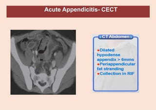 Acute Appendicitis- CECT
 