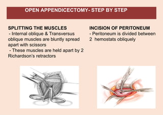 OPEN APPENDICECTOMY- STEP BY STEP
SPLITTING THE MUSCLES
- Internal oblique & Transversus
oblique muscles are bluntly spread
apart with scissors
- These muscles are held apart by 2
Richardson’s retractors
INCISION OF PERITONEUM
- Peritoneum is divided between
2 hemostats obliquely
 
