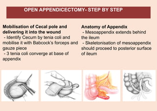 OPEN APPENDICECTOMY- STEP BY STEP
Mobilisation of Cecal pole and
delivering it into the wound
- Identify Cecum by tenia coli and
mobilise it with Babcock’s forceps and
gauze piece
- 3 tenia coli converge at base of
appendix
Anatomy of Appendix
- Mesoappendix extends behind
the ileum
- Skeletonisation of mesoappendix
should proceed to posterior surface
of ileum
 