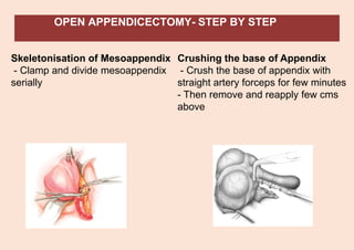 OPEN APPENDICECTOMY- STEP BY STEP
Skeletonisation of Mesoappendix
- Clamp and divide mesoappendix
serially
Crushing the base of Appendix
- Crush the base of appendix with
straight artery forceps for few minutes
- Then remove and reapply few cms
above
 