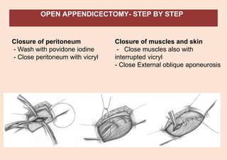 OPEN APPENDICECTOMY- STEP BY STEP
Closure of peritoneum
- Wash with povidone iodine
- Close peritoneum with vicryl
Closure of muscles and skin
- Close muscles also with
interrupted vicryl
- Close External oblique aponeurosis
 