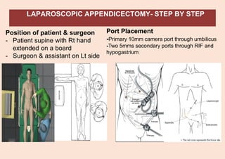 LAPAROSCOPIC APPENDICECTOMY- STEP BY STEP
Position of patient & surgeon
- Patient supine with Rt hand
extended on a board
- Surgeon & assistant on Lt side
Port Placement
-Primary 10mm camera port through umbilicus
-Two 5mms secondary ports through RIF and
hypogastrium
 