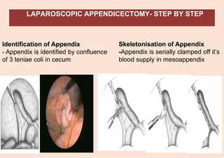 LAPAROSCOPIC APPENDICECTOMY- STEP BY STEP
Identification of Appendix
- Appendix is identified by confluence
of 3 teniae coli in cecum
Skeletonisation of Appendix
-Appendix is serially clamped off it’s
blood supply in mesoappendix
 