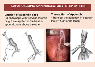 LAPAROSCOPIC APPENDICECTOMY- STEP BY STEP
Ligation of appendix base
- 3 endoloops with vicryl or chromic
catgut are applied in the base of
appendix one above the other
Transaction of Appendix
- Transact the appendix in between
the 2nd & 3rd endo-loops.
 