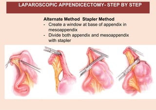 LAPAROSCOPIC APPENDICECTOMY- STEP BY STEP
Alternate Method Stapler Method
- Create a window at base of appendix in
mesoappendix
- Divide both appendix and mesoappendix
with stapler
 