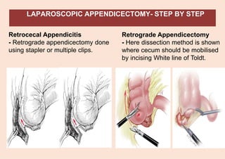 LAPAROSCOPIC APPENDICECTOMY- STEP BY STEP
Retrocecal Appendicitis
- Retrograde appendicectomy done
using stapler or multiple clips.
Retrograde Appendicectomy
- Here dissection method is shown
where cecum should be mobilised
by incising White line of Toldt.
 