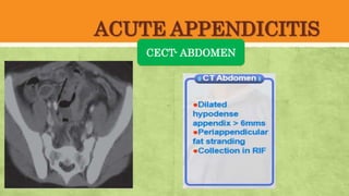 ACUTE APPENDICITIS
CECT- ABDOMEN
 