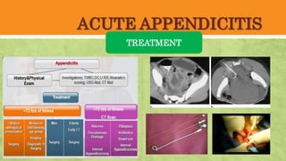 ACUTE APPENDICITIS
TREATMENT
 