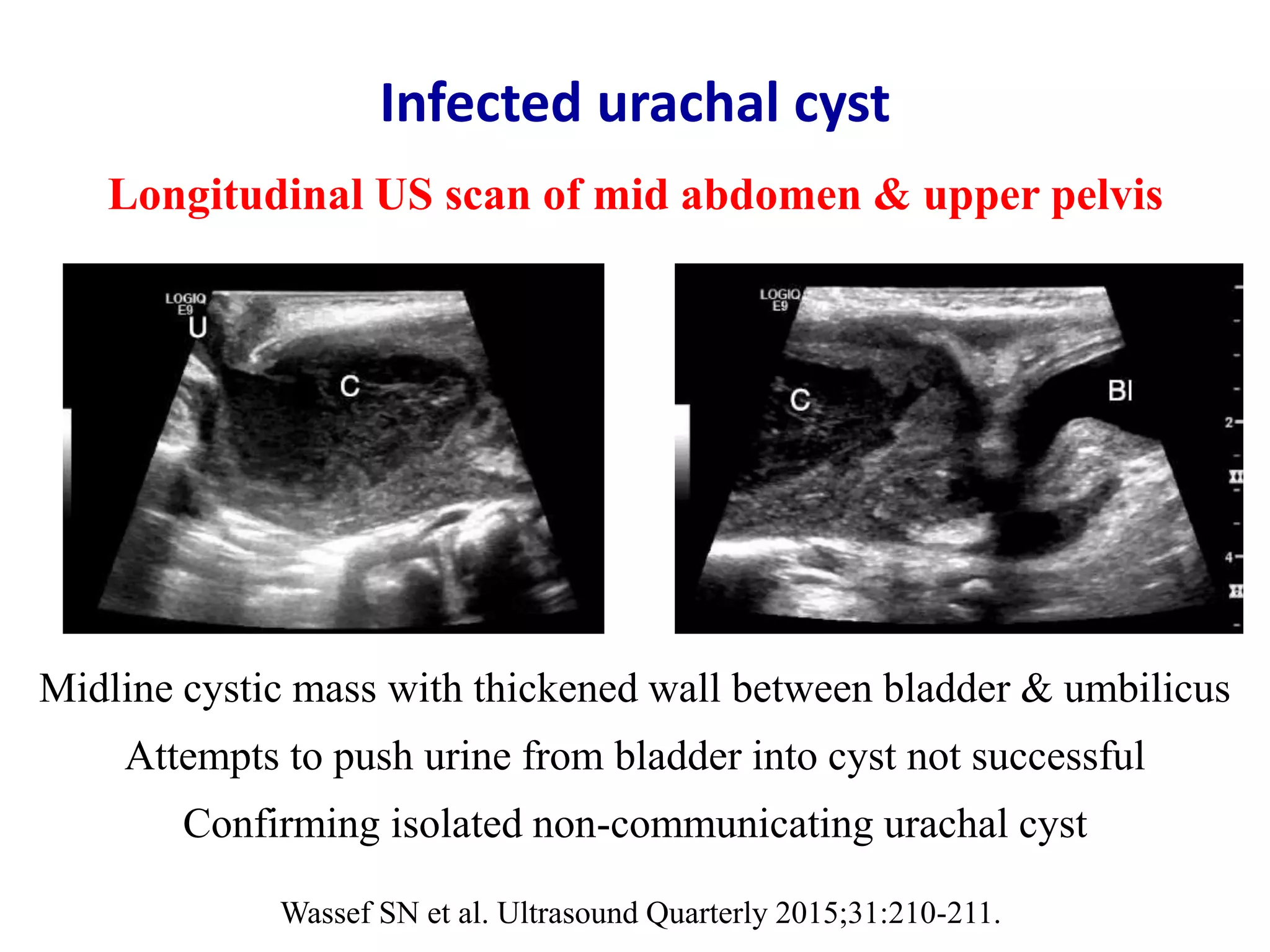 Acute appendicitis - Ultrasound first | PPTX
