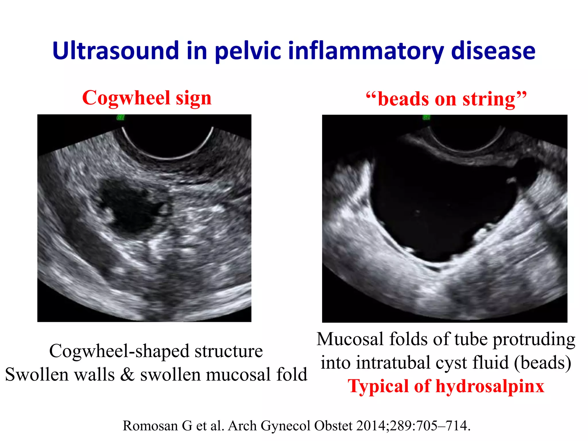 Acute appendicitis - Ultrasound first | PPTX
