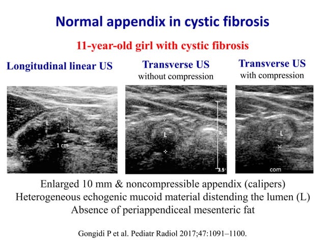 Acute appendicitis - Ultrasound first | PPT