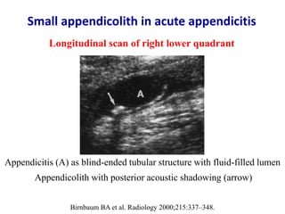 Acute appendicitis - Ultrasound first | PPTX