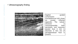 Acute appendicitis CME Ppresentation.pptx