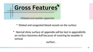 Acute Appendicitis_compressed.pptx mbbs 2nd year pathology | PPTX