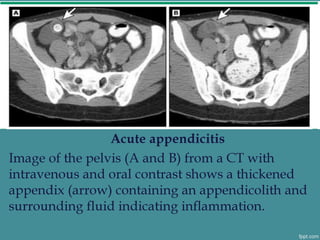 Acute appendicitis in adults - Hoang Cuong HMU | PDF