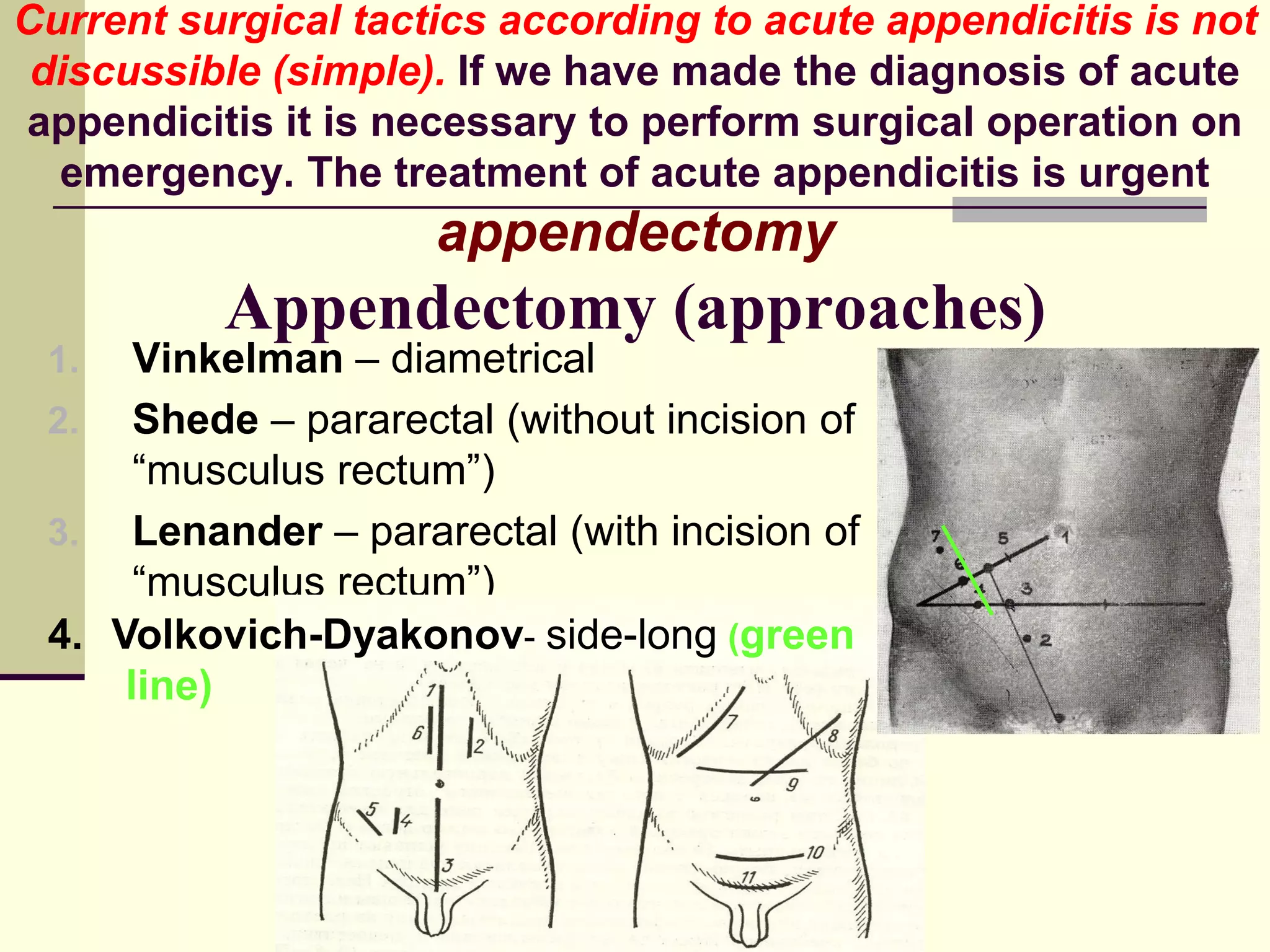 Acute appendicitis(lecture vasilevsky v.p.) | PDF