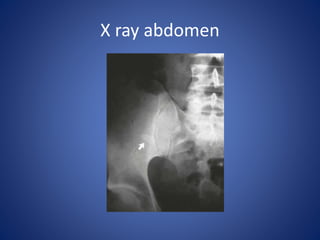 Acute appendicitis &lump | PPTX