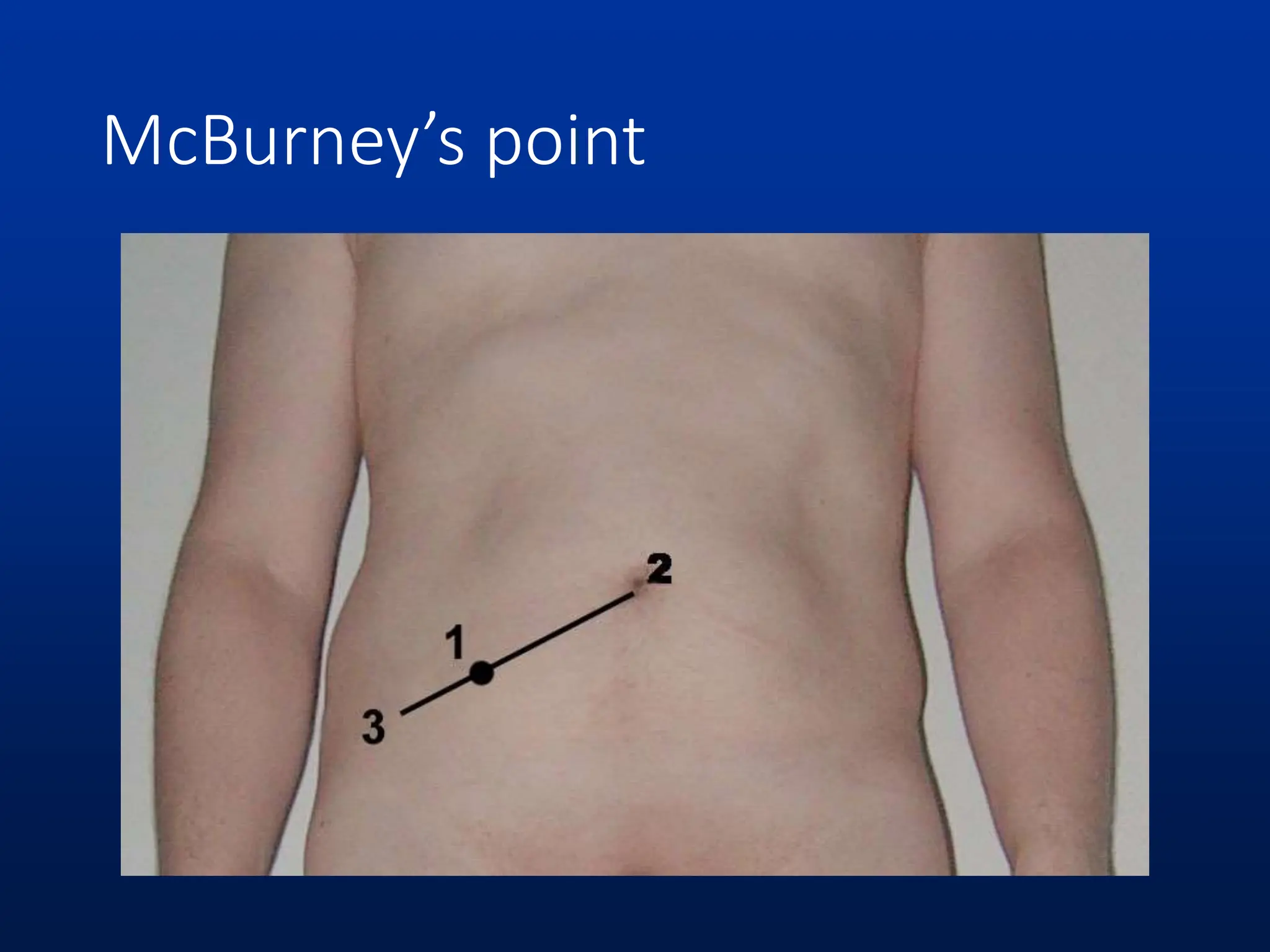 McBurney’s point
 