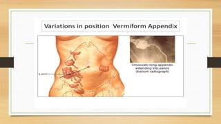 Acute appendicitis presentation | PPTX