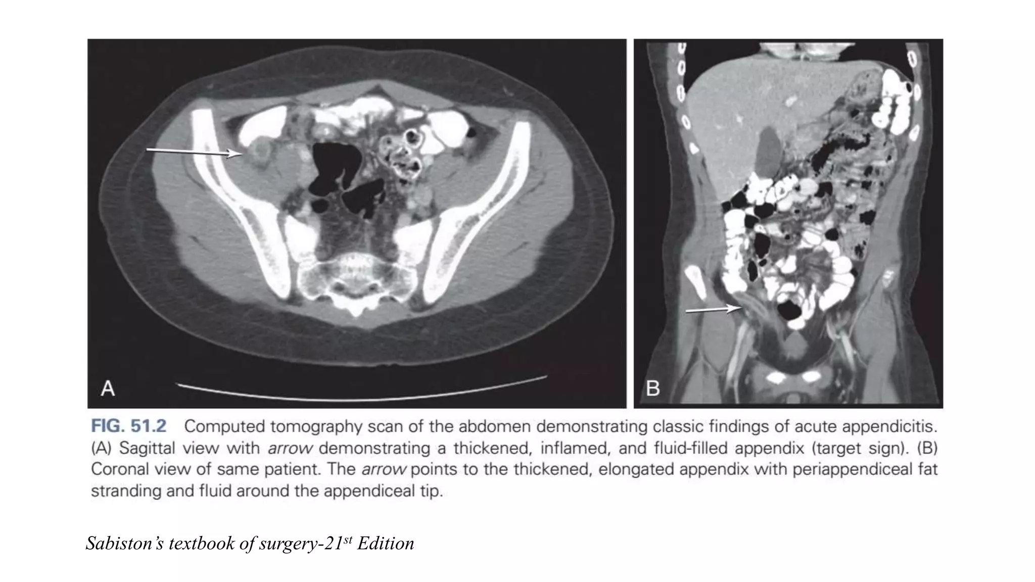 Acute Appendicitis | PPTX