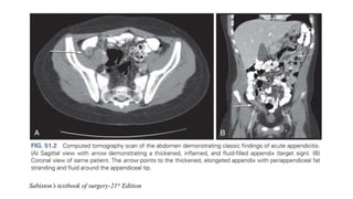 Acute Appendicitis | PPTX