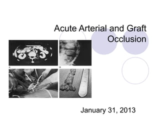 Acute Arterial and Graft
Occlusion
January 31, 2013
 
