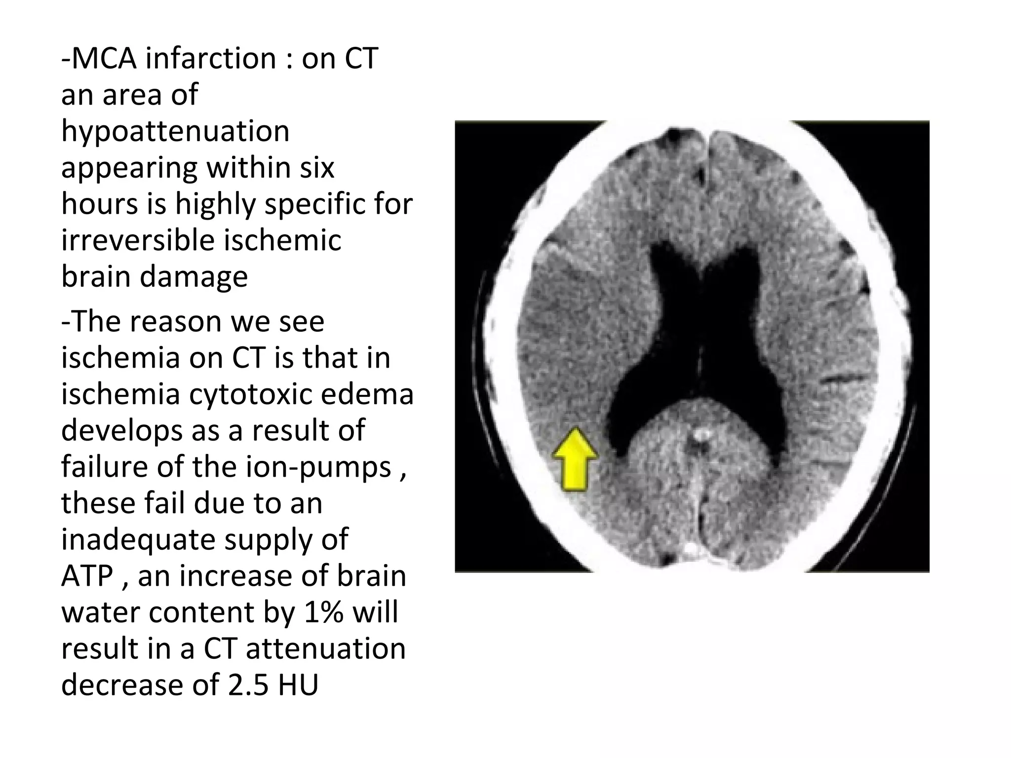 -MCA infarction : on CT
an area of
hypoattenuation
appearing within six
hours is highly specific for
irreversible ischemic
brain damage
-The reason we see
ischemia on CT is that in
ischemia cytotoxic edema
develops as a result of
failure of the ion-pumps ,
these fail due to an
inadequate supply of
ATP , an increase of brain
water content by 1% will
result in a CT attenuation
decrease of 2.5 HU
 