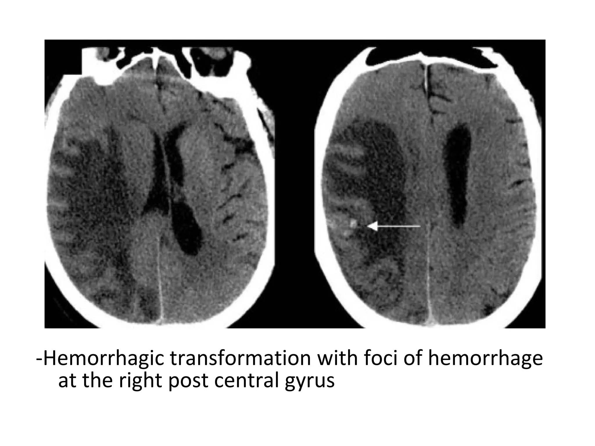 -Hemorrhagic transformation with foci of hemorrhage
at the right post central gyrus
 